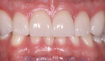 lasting porcelain veneers