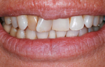 Dental candidate for Veneers