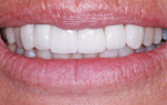 After Veneers are added