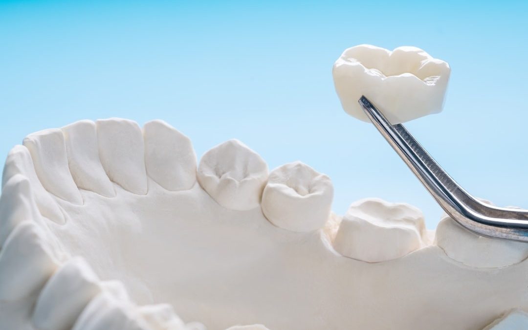 Crowns and Implants: Restoring Your Smile with Confidence
